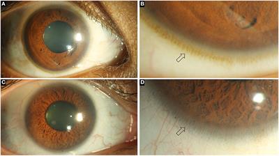 A Review of the Diagnosis and Treatment of Limbal Stem Cell Deficiency